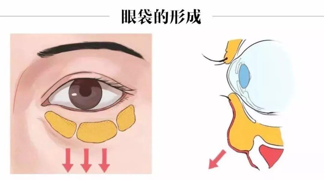 去眼袋眼霜：日常护理中的关键眼部产品
